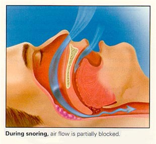 Ngủ ngáy - Tác hại khôn lường 2