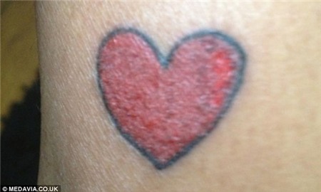 Xăm hình trái tim lên chân, người phụ nữ bị phồng rộp kinh hoàng 2