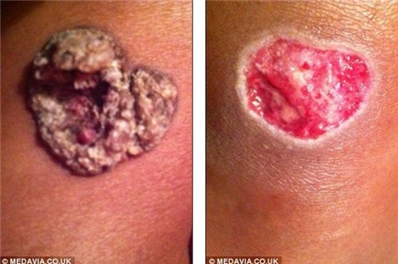 Xăm hình trái tim lên chân, người phụ nữ bị phồng rộp kinh hoàng 4