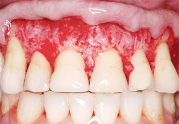 Làm trắng răng bằng miếng dán - Lợi hay hại nhiều? 4