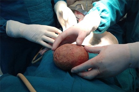 Hòn đá nặng gần 1 kg lấy từ bàng quang | Chuyện lạ 4 phương,Chuyện lạ thế giới,Phi thường,Chuyện lạ có thật,Chuyện lạ khó tin