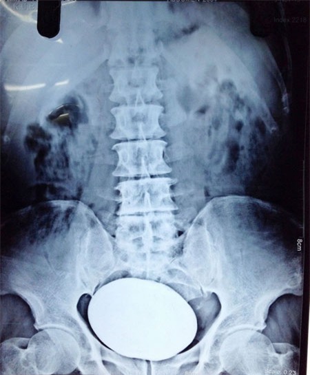 Hòn đá nặng gần 1 kg lấy từ bàng quang | Chuyện lạ 4 phương,Chuyện lạ thế giới,Phi thường,Chuyện lạ có thật,Chuyện lạ khó tin