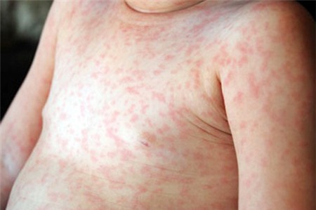 Hữu ích: Bác sĩ giúp mẹ phân biệt bệnh sởi và sốt phát ban 1