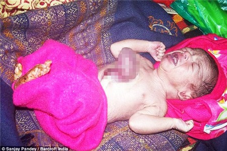 Bé trai chào đời với trái tim nhô ra khỏi lồng ngực | Cơ thể kỳ lạ,căn bệnh hiếm gặp,em bé,Ấn Độ,chào đời.