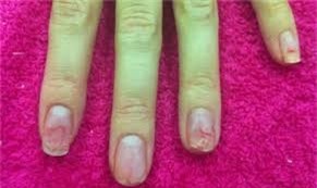 Mất móng vì dùng sơn, chất tẩy giá rẻ.