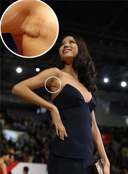 Cựu Hoa hậu Thế giới Trương Tử Lâm lộ sẹo nâng ngực 2
