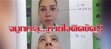 Cặp đôi Thái Lan bị biến dạng mũi do phẫu thuật thẩm mỹ hỏng 2