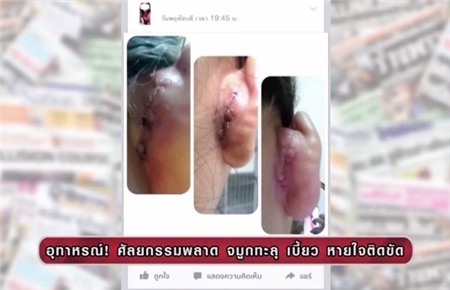 Cặp đôi Thái Lan bị biến dạng mũi do phẫu thuật thẩm mỹ hỏng 3