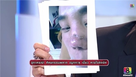 Cặp đôi Thái Lan bị biến dạng mũi do phẫu thuật thẩm mỹ hỏng 6