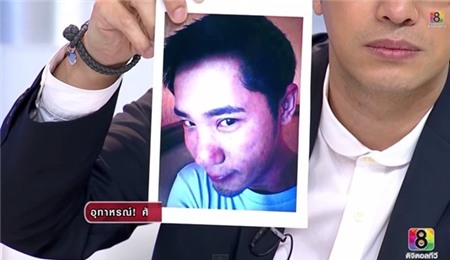 Cặp đôi Thái Lan bị biến dạng mũi do phẫu thuật thẩm mỹ hỏng 7