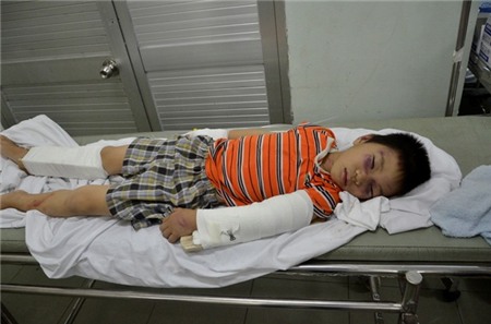 Bé trai bị người tình của mẹ đánh gãy tay chân