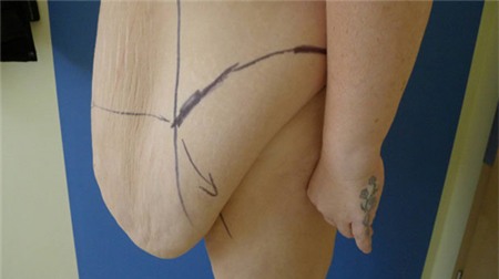 Da thừa chảy xệ tới gần đầu gối sau khi giảm cân - 1