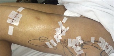 Á hậu Siêu vòng 3 có thể bị cắt cụt chân vì bơm đùi - 2