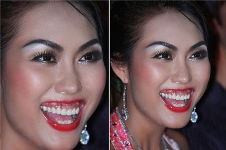 Phi Thanh Vân, teo mũi, biến chứng, phẫu thuật thẩm mỹ, da trắng