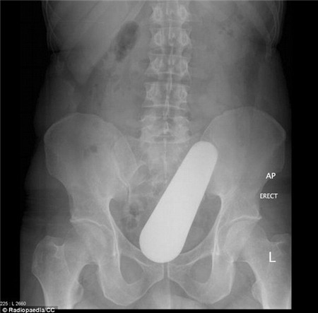 Những món đồ kỳ lạ được tìm thấy trong cơ thể người 1