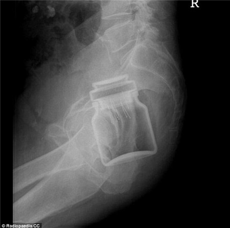 Những món đồ kỳ lạ được tìm thấy trong cơ thể người 2