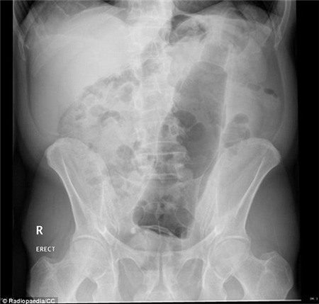 Những món đồ kỳ lạ được tìm thấy trong cơ thể người 3