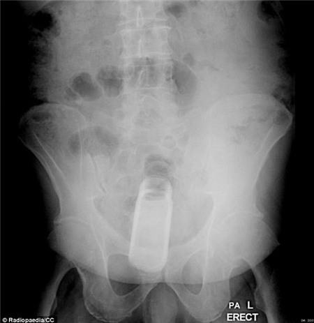 Những món đồ kỳ lạ được tìm thấy trong cơ thể người 6