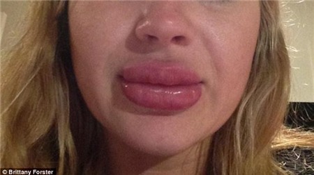 Cô gái bị sưng vù môi do tuỳ tiện mua hàng qua mạng