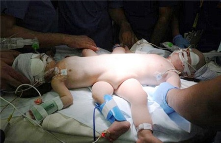Phẫu thuật thành công cho 2 bé trai dính liền thân