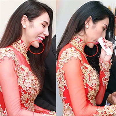 Những biến chứng thường gặp với các phương pháp PTTM đang hot 17