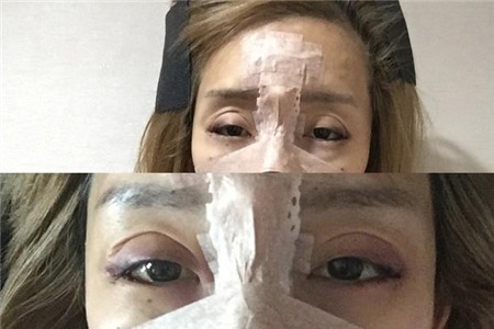 Những biến chứng thường gặp với các phương pháp PTTM đang hot 25