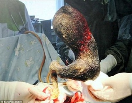 Kinh di bui toc nang 4kg nam trong bung