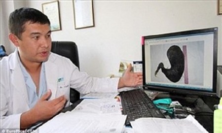 Kinh di bui toc nang 4kg nam trong bung