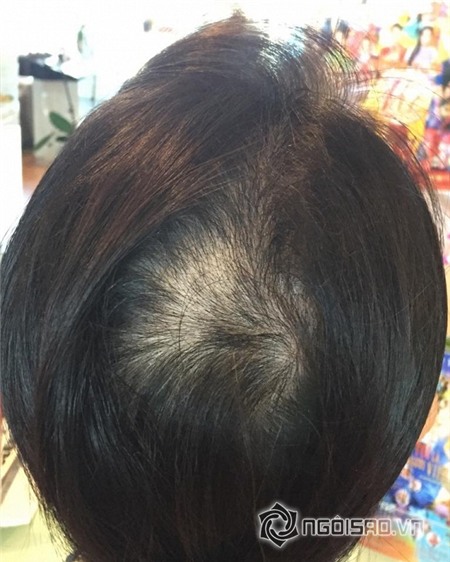 MC Kỳ Duyên bị cháy tóc 1