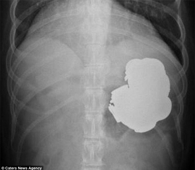 Ảnh chụp X-quang cho thấy vùng kim loại tích tụ trong dạ dày, phần màu trắng.