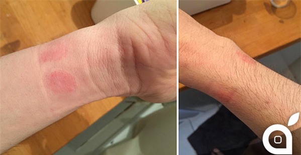 Nhiều người bị dị ứng da khi đeo Apple Watch