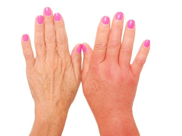 Bàn tay nói gì về sức khỏe của bạn?