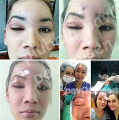Co gai Thai mu mat sau khi trung tu nhan sac