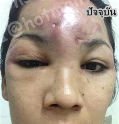 Co gai Thai mu mat sau khi trung tu nhan sac