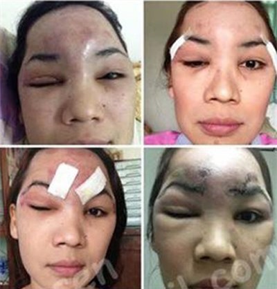 Co gai Thai mu mat sau khi trung tu nhan sac