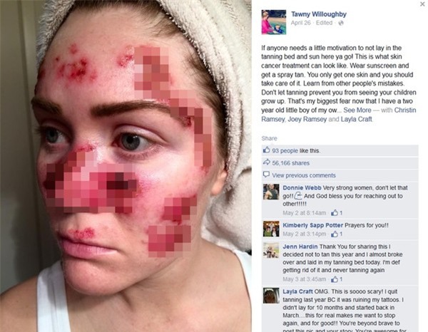 Bức ảnh cảnh báo ung thư da của bà mẹ dũng cảm hút 50.000 lượt share