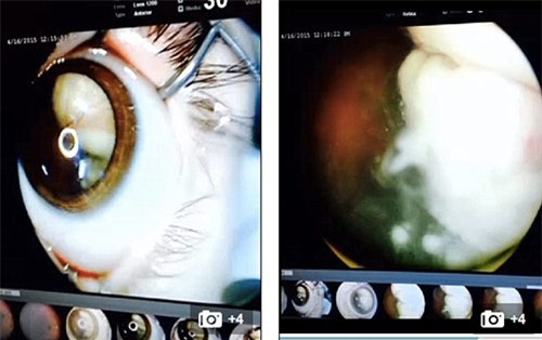 Bố Việt cảnh báo cha mẹ kiểm tra ung thư mắt trẻ bằng iPhone - 2