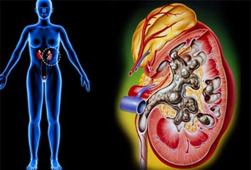 Ăn quá nhiều mận có thể gây sỏi thận (Ảnh minh họa)