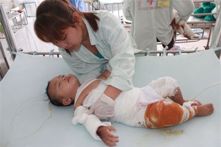 Bé Đại Thiên bị bỏng 40% cơ thể, trong đó nặng nhất phần bụng, lưng, đùi và tứ chi