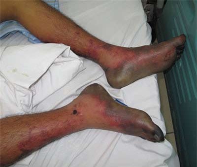 Nguy kịch vì nhiễm liên cầu lợn từ tiết canh