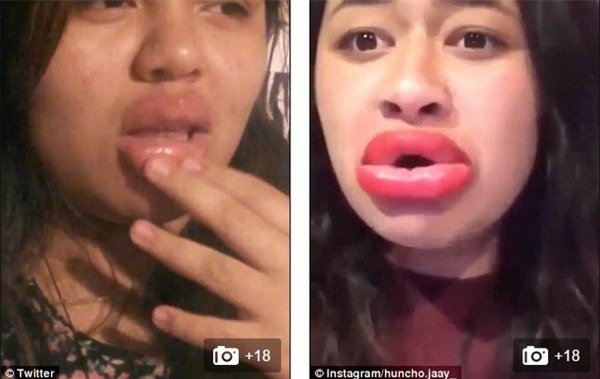 Trào lưu kì quái: Hít chai làm môi sưng vù