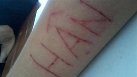 Rạch cơ thể để thể hiện bản lĩnh, trào lưu quái gở của một số bạn trẻ.