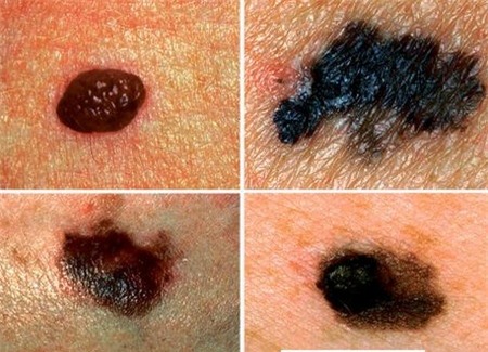 Hắc tố và khối u trên da người bị ung thư da
