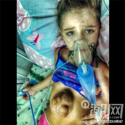 Kinh ngạc bé 5 tuổi có trái tim ngoài lồng ngực - 3