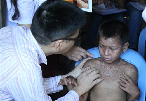 bệnh lạ, Thanh Sơn, Phú Thọ, nốt đen, ánh nắng, tử vong, khô da sắc tố