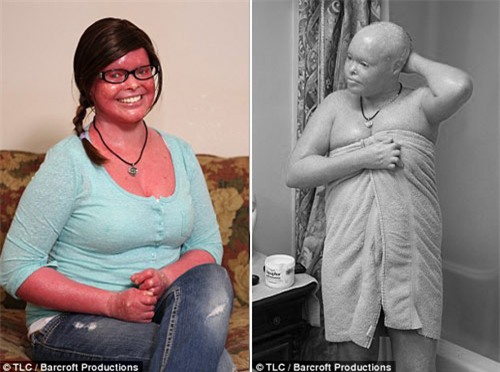 Chuyện sinh con kỳ diệu của mẹ mắc bệnh da vảy cá - 1