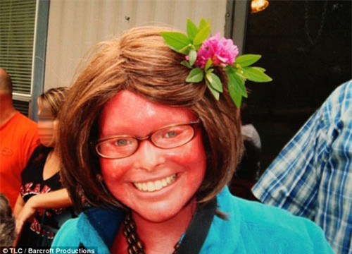 Chuyện sinh con kỳ diệu của mẹ mắc bệnh da vảy cá - 3