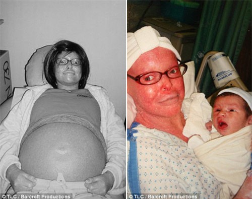 Chuyện sinh con kỳ diệu của mẹ mắc bệnh da vảy cá - 4