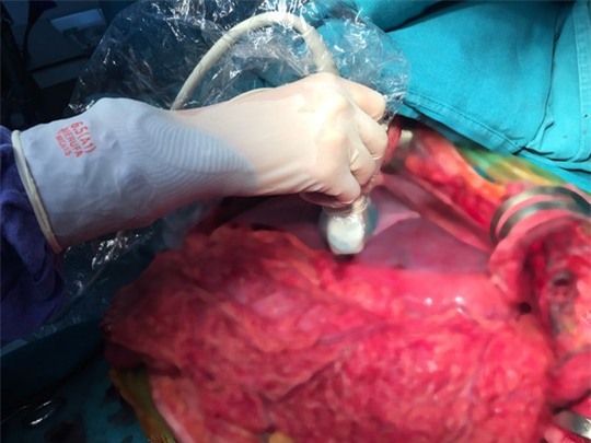 Những hình ảnh lần đầu công bố về ca ghép tạng xuyên Việt - 25