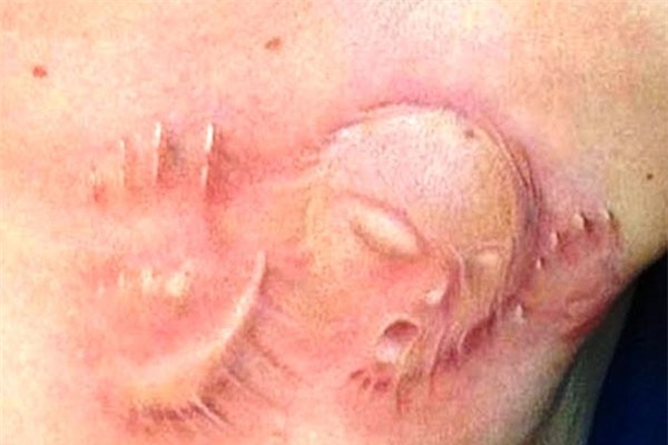 Thú xăm hình tạo sẹo tiềm ẩn nhiều nguy cơ lây nhiễm bệnh.